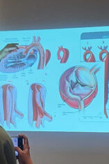 Kecepatan Menjadi Kunci Penyelamatan Nyawa pada Penanganan Penyakit Aorta Kompleks di Era Modern